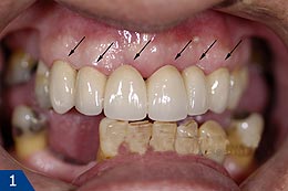 Металлокерамика